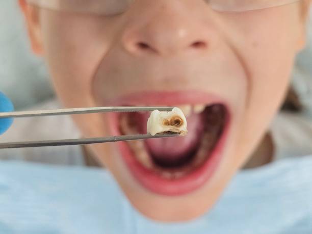 Best Dentist for Tooth Abscess  in Ottawa, OH